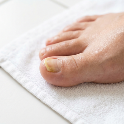 Pedialux™ — Tratamiento Antifúngico de Uñas